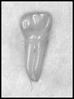 and a right supernumerary tooth in the mandibular anterior tooth area (Figs. 6, 7 and 8). Treatment was performed, extracting two incisors and the bilateral maxillary first premolars.