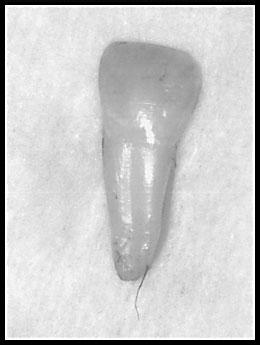 Discussion In patient 1, the fused tooth in the left mandibular lateral incisor area was considered to be a fused tooth comprising a lateral incisor and a supernumerary tooth.