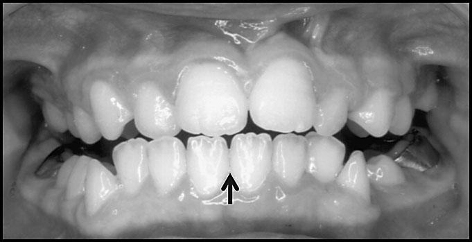 22 Yokose T et al. Fig. 6 Intraoral photographs Mark shows mandible dental midline, determined by positional relationship of lingual frenum and inferior labial frenum. Fig. 7 Mark shows mandible dental midline Fig.