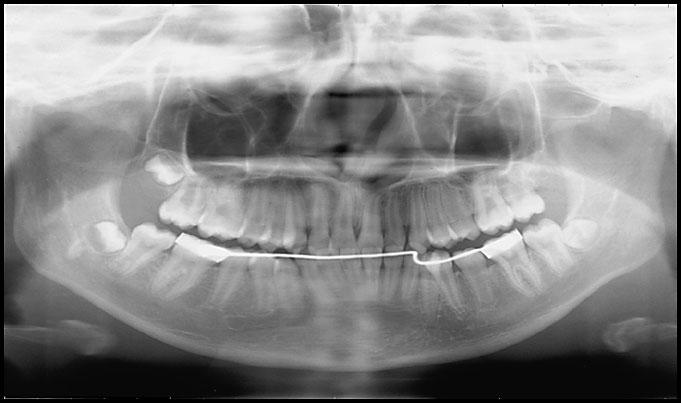 In patient 2, since no significant differences in the tooth crown width were noted among the anterior teeth, differentiation of a supernumerary tooth was impossible.