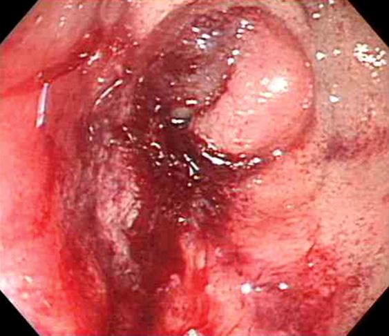 Cystic lesions in the head of pancreas at the interface with the duodenum were observed in 2 cases and mass-like lesions on the head of pancreas in 3 patients (Fig. 1).