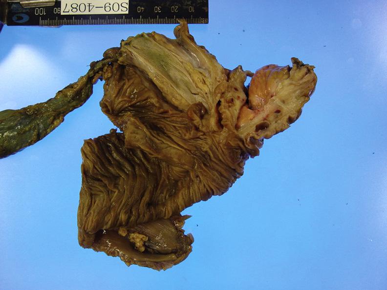 Groove pancreatitis Fig. 3. Gross findings. A specific form of chronic pancreatitis that extended into anatomical area between pancreatic head, duodenum, and common bile duct is shown. Fig. 4.