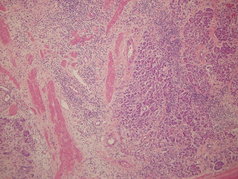 In the 68-year-old woman without a history of alcoholism or smoking, histologic analysis revealed surrounding foci of adenocarcinoma of the distal common bile duct.