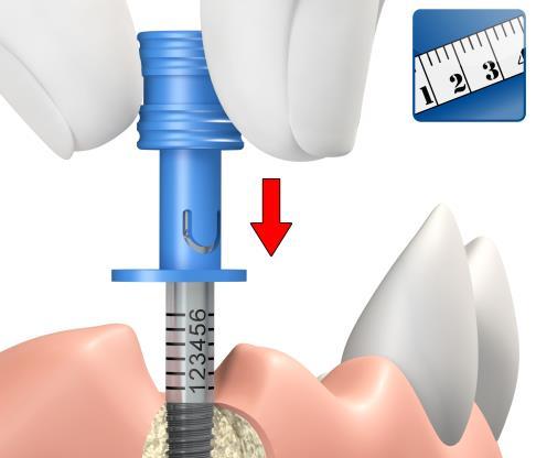 6.2 Measuring procedure Place on implant