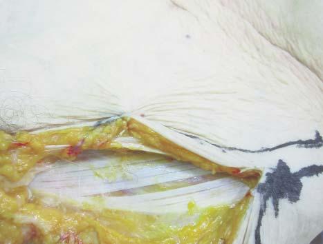 The Rubens Flap - Breast Reconstruction - Anatomical Dissection on a Cadaver 325 Figure 3.