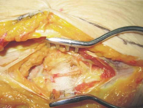 The incision of the inguinal ligament, to expose the internal oblique muscle (which represents the floor of the inguinal region.