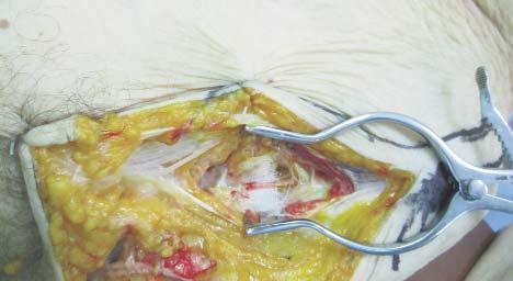 The dissection of the vascular pedicle: the deep circumflex iliac artery and the deep circumflex iliac vein Figure 7.