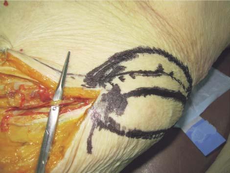 The deep circumflex iliac artery accompanied by the deep circumflex iliac vein are