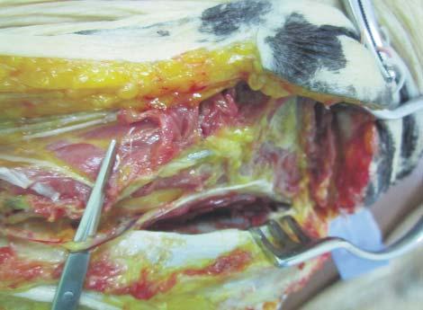 The Rubens Flap - Breast Reconstruction - Anatomical Dissection on a Cadaver 327 Figure 15.