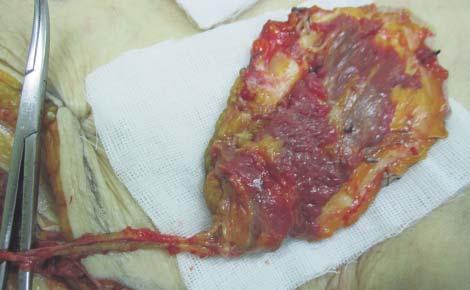 The vascular pedicle is tensed up during the dissection for a better viewing and avoiding its accidental injury Figure 17.