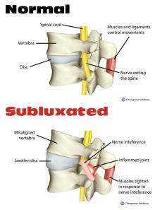 Huh? Q: Which subluxation codes should DCs be using for major medical claims?