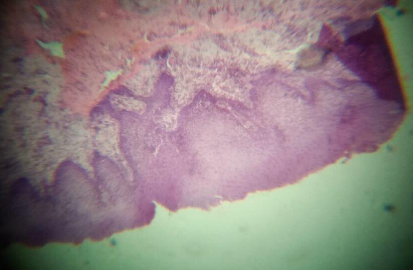FIG. HISTOPATHOLOGY OF MUCOCELE SHOWING MUCOSAL EPITHELIUM BENEATH IT GRANULATION TISSUE WITH COLLECTED MUCIN AND INFLAMMATORY CELLS IV.