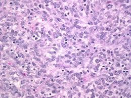 but mostly normal appearing fibroblasts Local mass/tumor