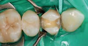 Excavated teeth Tooth 15 has