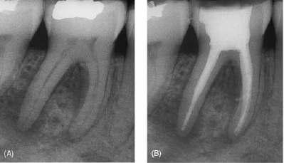 fig 1. Primary endodontic disease in a mandibular first molar with a necrotic pulp. (A) Preoperative radiograph showing periapical and interradicular radiolucncies.
