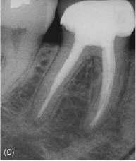 Primary endodontic lesions with secondary periodontal involvement may also occur as a result of root perforation during root canal treatment, or where pins or posts have been misplaced during coronal