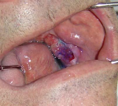 Discussion Mucous overgrowth (epulis fissuratum) due to prolonged wearing of movable prosthetic dentures gives raise to diagnostic difficulties with a number of pathological processes in the oral