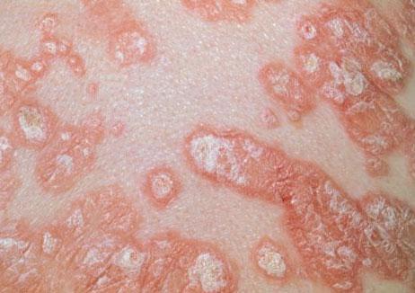 SPL Systemic therapy Antimetabolites Methotrexate is an antimetabolite agent that has been used for many years in psoriasis treatment and remains one of the most effective therapies.