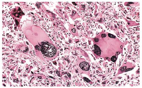 Features of the anaplastic cells Pleomorphy: variability in size and shape Rhabdomyosarcoma Aberrant nuclear