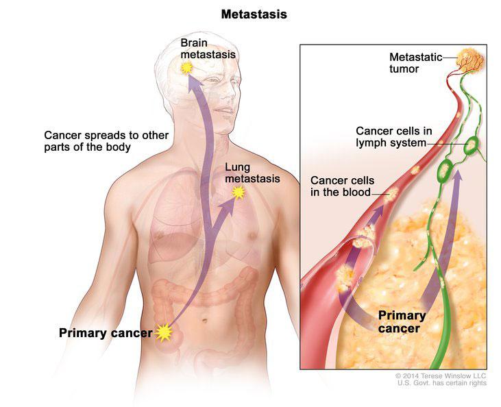 Pathways of dissemination: Seeding within body cavities: e.g. ovarian carcinoma, peritoneal surface Lymphatic spread: mainly carcinomas, sentinel lymph node, skipping mets Hematogenous spread: mainly through veins portal circ.