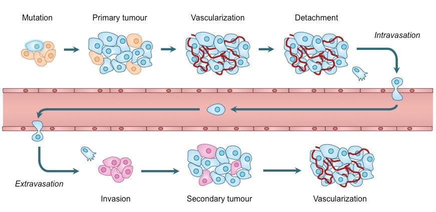 Metasztatikus kaszkád Detachment of tumor cells ECM and BM