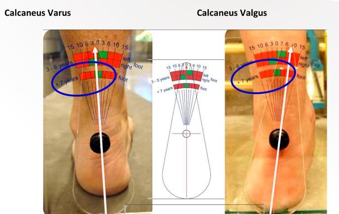 Fit Feet HAS Section: Biomechanics, Joint Range of Motion: Part 1- Foot Structure Foot Structure/Foot Relaxed Calcaneal Stance Position What are you looking for: 1.