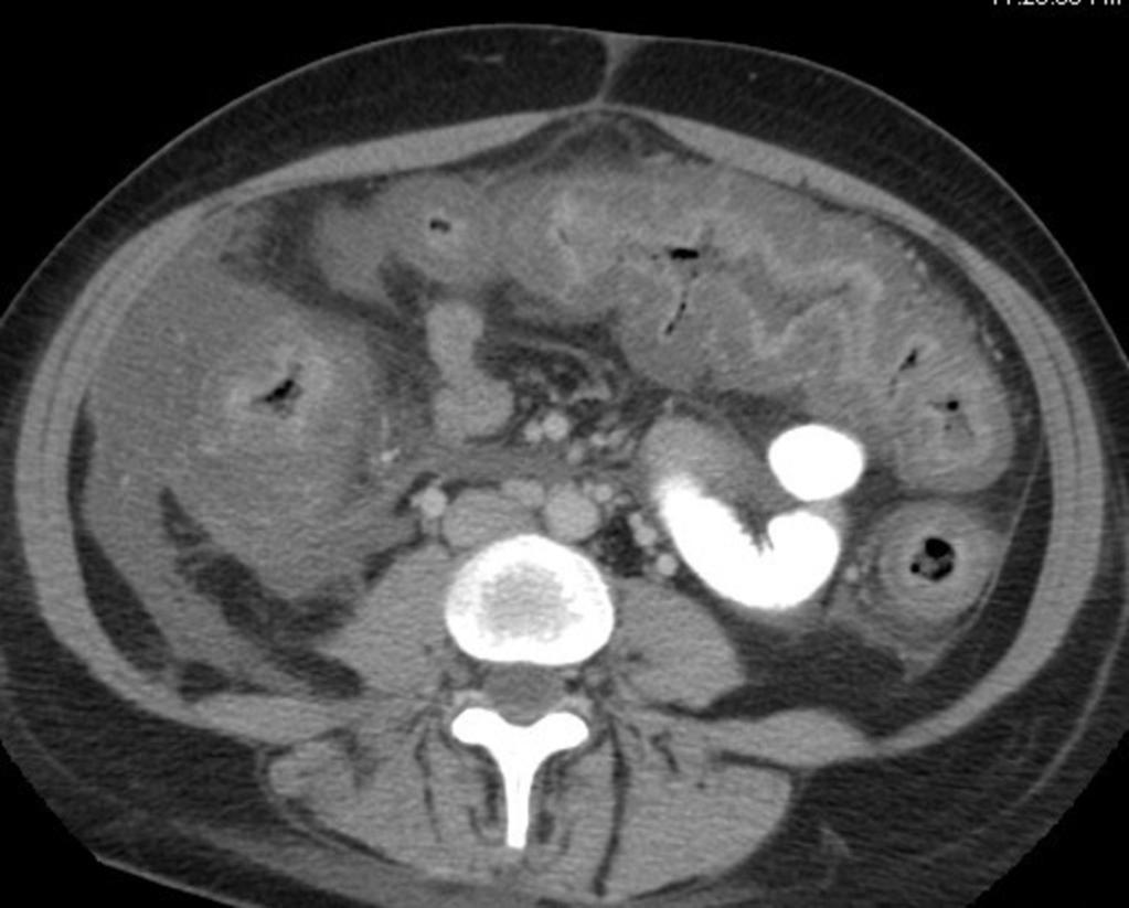 Fig. 22: Figure 22. CT scan shows eccentric thickening of the colon.