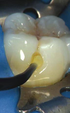 For indirect restorations, clean the preparation for etching, and