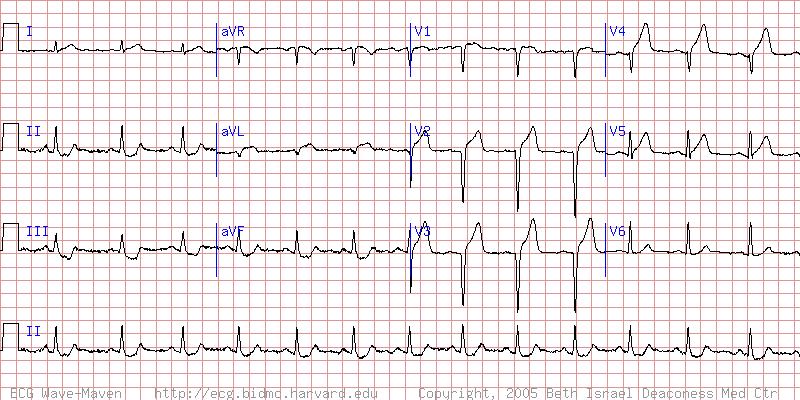 34 y/o man with chest pain -NSR -Anterior and lateral STsegment elevation