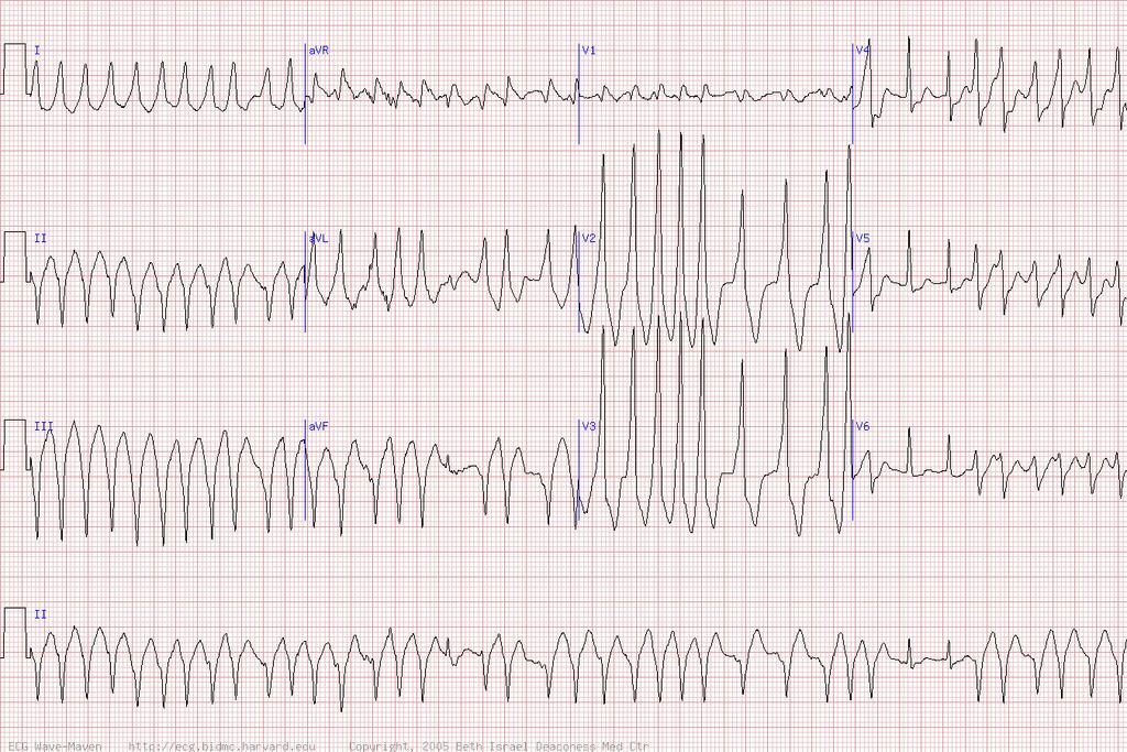 59 y/o woman with sudden palpitations and lightheadedness Atrial fibrillation with pre-excitation through a WPW bypass tract -Note the delta waves and exceptionally fast rate.