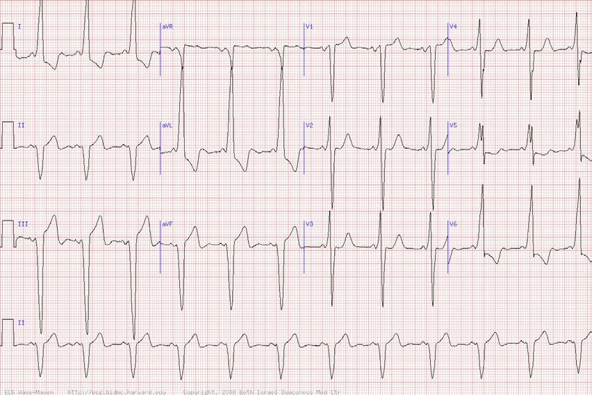 39 y/o man with very abnormal ECG -NSR with WPW conduction See again the WPW triad The delta wave is downgoing in II, II, and avf, and have