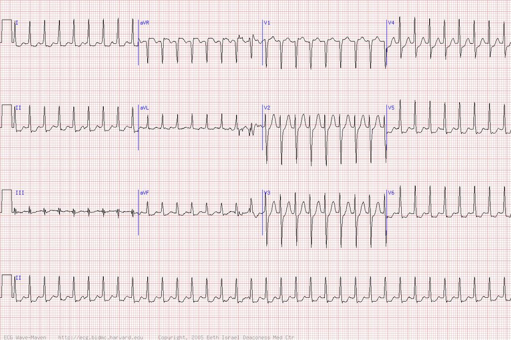 60 y/o woman with sudden onset of palpitations -AV nodal reentrant tachycardia (AVNRT) -Very regular -Very fast -Caused by reentry loop in AV node -The atria and ventricles are stimulated almost
