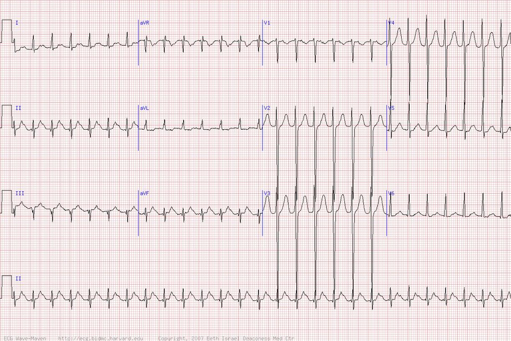 54 y/o man with palpitations who had a MV replacement -Paroxysmal supraventricular tachycardia 160 bpm -Note the P waves embedded in the T-waves in lead II