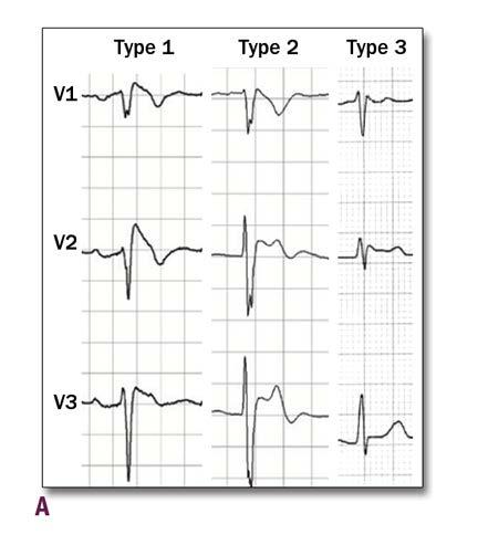 -NSR with Brugada Type 1 ECG pattern