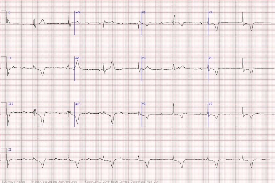 69 y/o woman with atrial tachycardia following one procedure and before another -Atrial tachycardia with more than one focus and complete