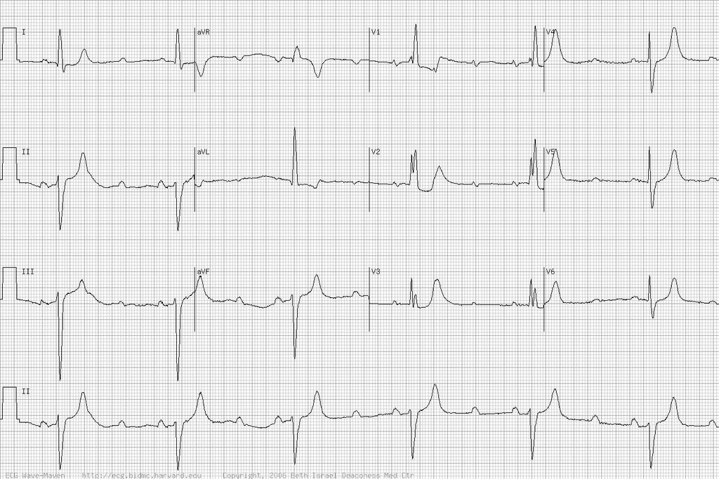 Elderly man with profound weakness -Sinus tachycardia with 4:3 Mobitz 2 second