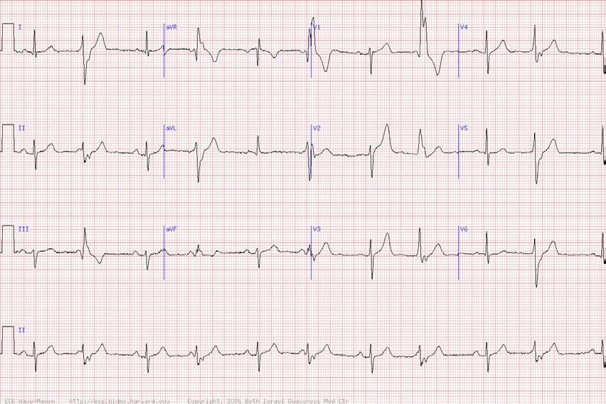 Patient with palpitations -NSR with alternating wide QRS complexes. -This is ventricular bigeminy with coupled PVC s fusing with every other conducted beat. The PVC morphology is that of RBBB.