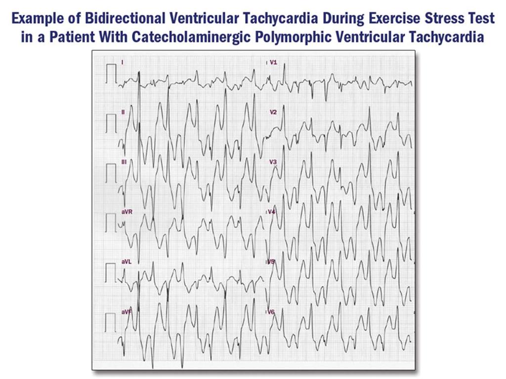 This ECG was obtained during a treadmill stress test -Bidirectional ventricular tachycardia -It is a polymorphic VT with alternating left and right axis deviation -It may be seen in digitalis