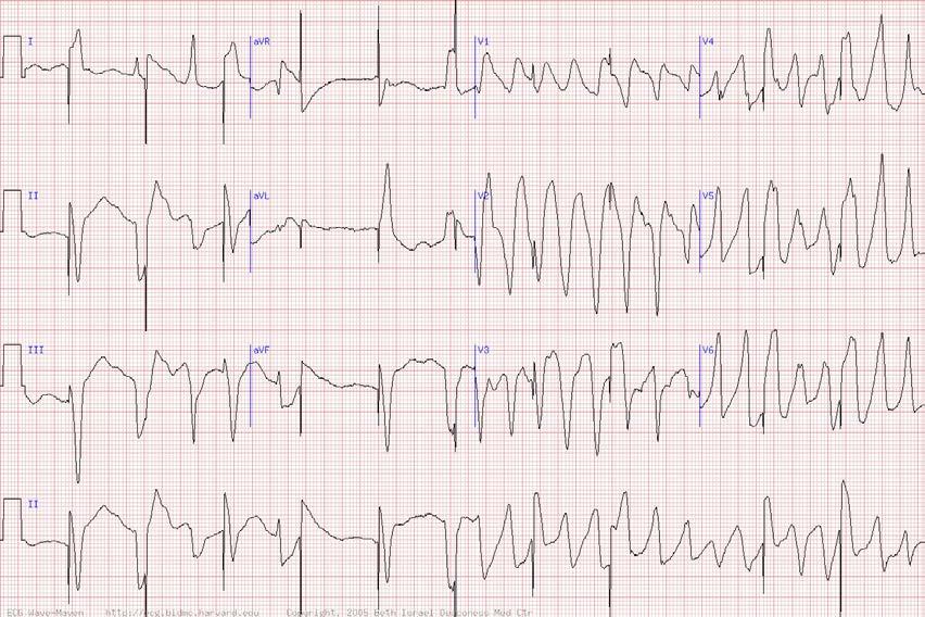 74 y/o woman with syncope -Atrial fibrillation with ventricular pacing and failure to sense (seen throughout tracing) -Polymorphic ventricular tachycardia of
