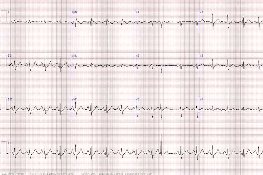 68 y/o man with dyspnea -Low grade sinus tachycardia -Peaked P-wave in II (ppulmonale) with a right ward p-wave axis (inverted p-wave