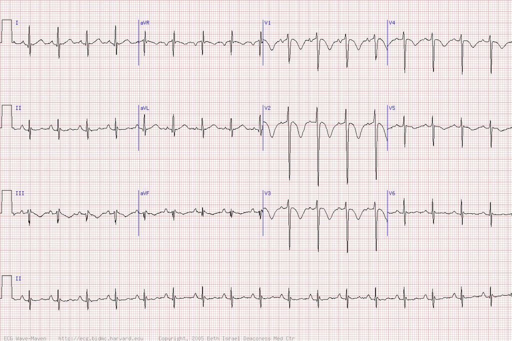 39 y/o man with dyspnea and a muscle strain in his left leg -Sinus tachycardia -Right precordial T wave inversion -Late QRS