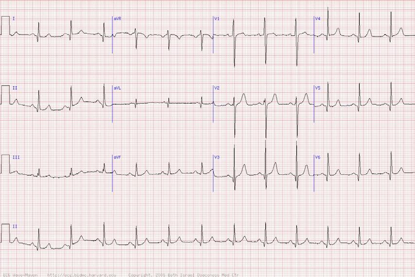 35 y/o man with systolic heart murmur -NSR with prominent septal voltage in V1 and V2 -Deep
