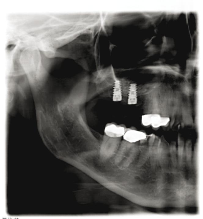 Indication: Shortened dental row.