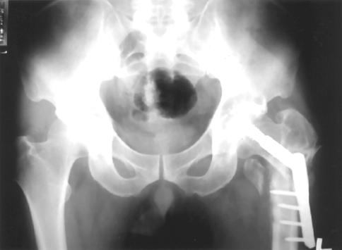 66 6 17 10-16 % 6 Fig 1 Anteroposterior radiograph of the both hip At the time of initial nonunion state there are screw failure and nonunion A B C D Fig 2 A Schematic operation (left At the time of