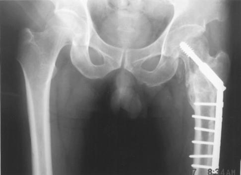 68 A C B Fig 3 A Anteroposterior radiograph of the both hip At the time of reoperation impacted cancellous allograft valgus fixation and autograft are done B Anteroposterior