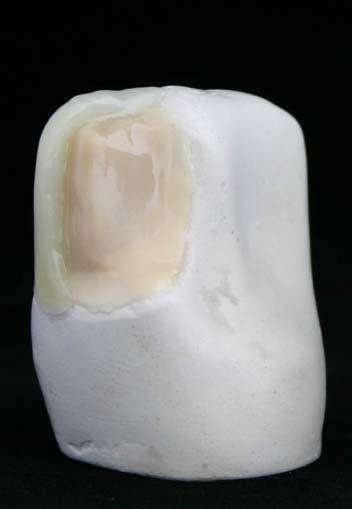 two-layer concept Core from opaque material Dentine shade Not translucent Shell/outside layer from translucent material Shade depth Variation Incisal edge