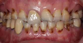 disease Dental history Findings in masticatory system Restorative history Endodontic history Personal habits Smoking(-) Alcohol drinking(-) Betel nuts