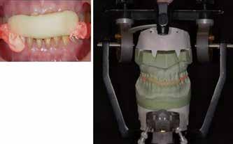 periodontitis Xerostomia Tentative treatment plan 1. Oral hygiene reinforcement 2. Caries restoration 3. Daily Fluoride application (1.23%NaF) 4.