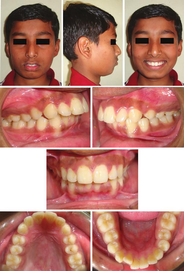 igs 5 to : Posttreatment extraoral and intraoral photographs of case 1 igs 6 and : () Posttreatment
