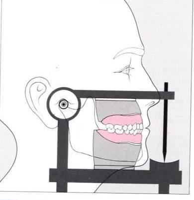 Articulators It is a mechanical device represents the TMJ, maxillary and mandibular arches.